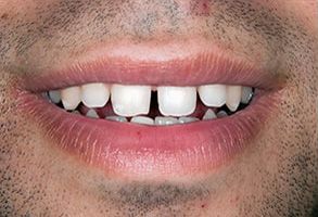 This image features a close-up of a person s mouth with teeth showing, displaying a smile with a visible gap between two front teeth.