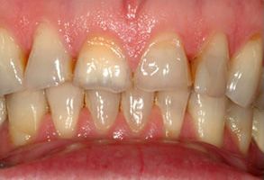 The image displays two photos side by side  on the left, there s a close-up view of a person s teeth with significant discoloration and decay  on the right, the same mouth appears after dental treatment, showing a noticeable improvement in dental hygiene with cleaner teeth.